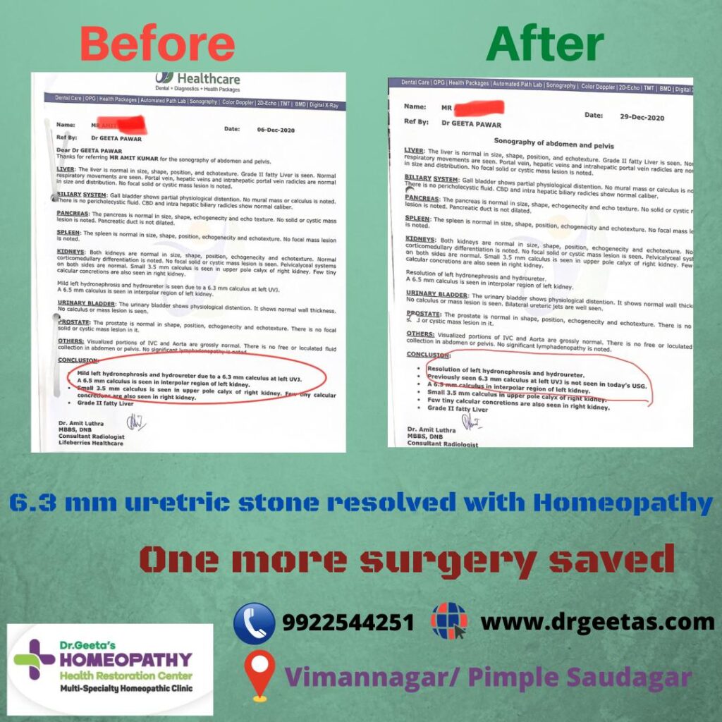 homeopathy cure kidney stone