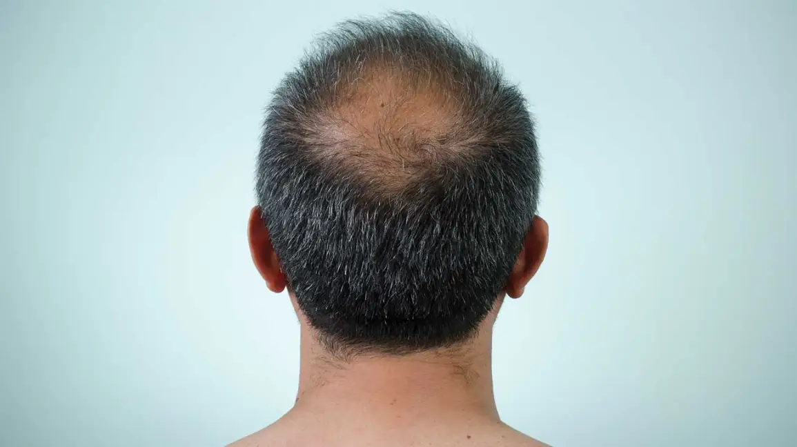 Best Homeopathy Treatment For All Hair Conditions