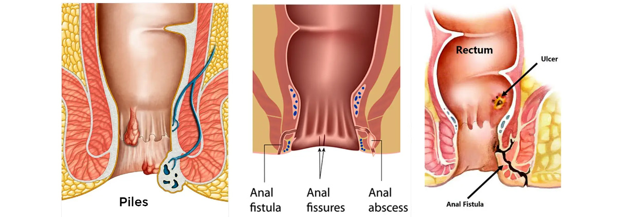 Best Homeopathy Treatment for Piles Fissure and Fistula