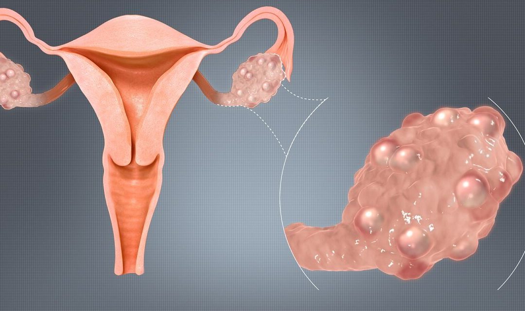 PCOD- Efficasy of Homoeopathic medicine