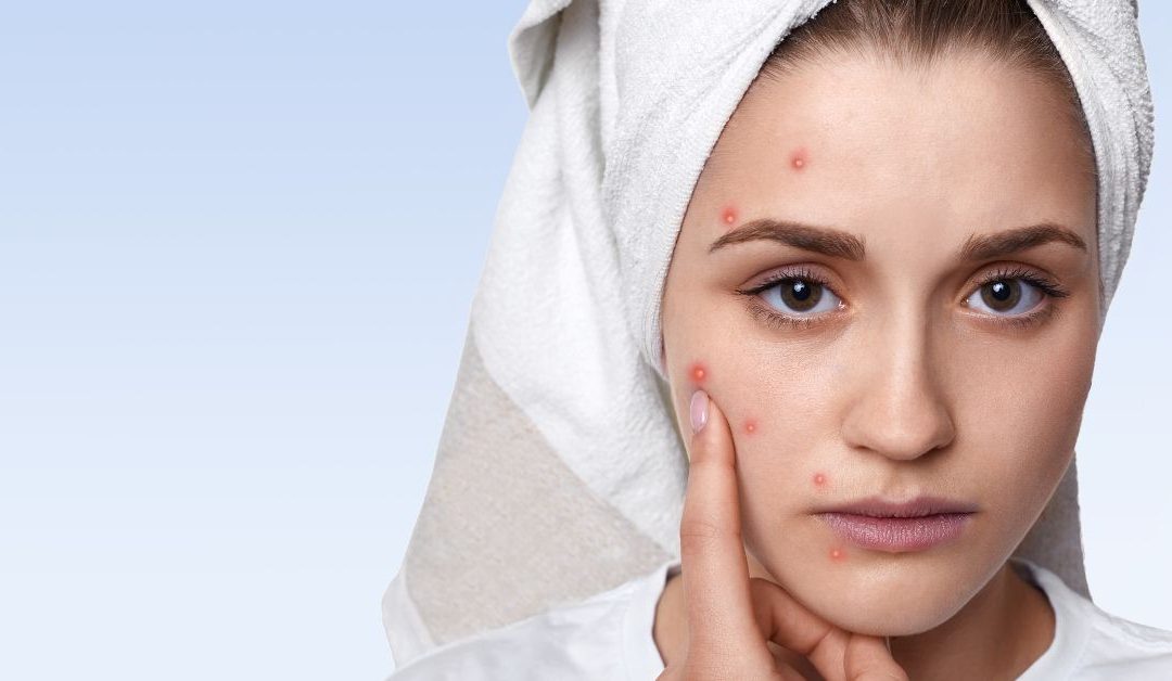 Acne- Homoeopathic review