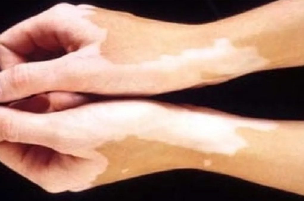 Leucoderma/ Vitiligo & Homoeopathy